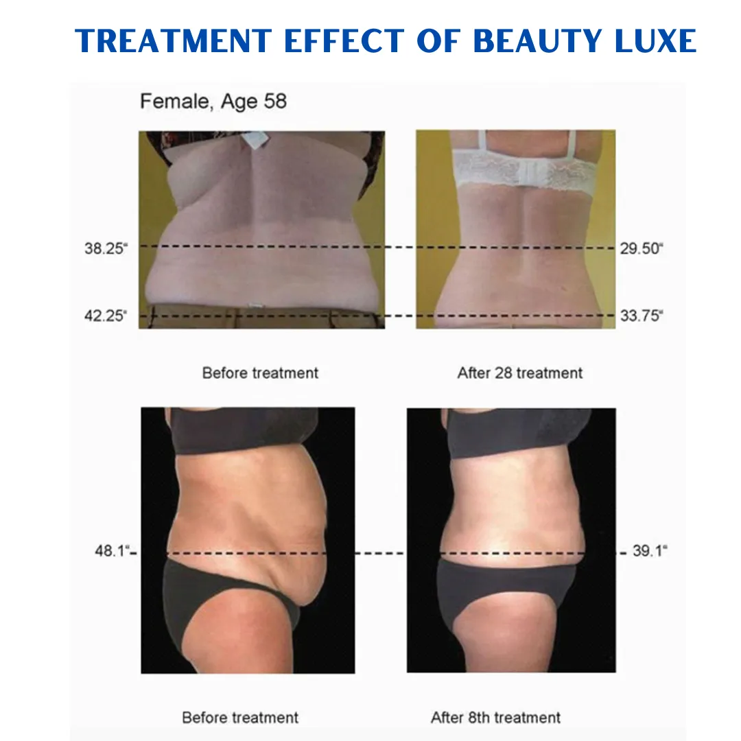 Beauty-Luxe Cavitation Machine